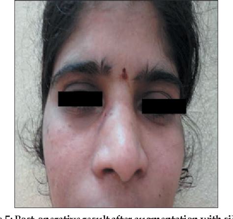 Figure From Idiopathic Calcinosis Cutis Of Nasal Dorsum Semantic