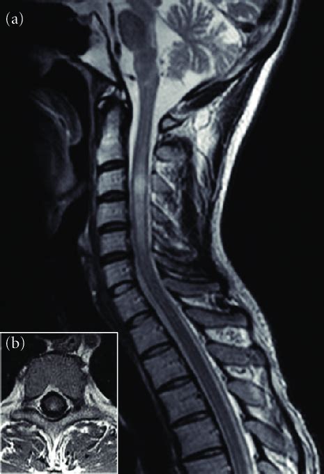 Sagittal A And Axial B T Weighted Mri Sequences Disclose Cervical