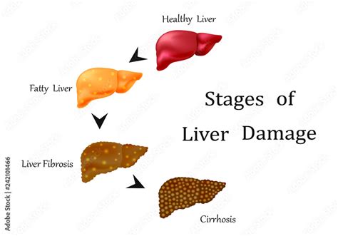 Stages of liver damage, liver disease. Healthy, fatty, liver fibrosis ...