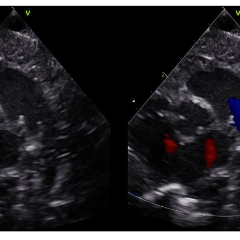 Doppler Pulse Wave Measurements Of Ductus Arteriosus Flow Three Download Scientific Diagram