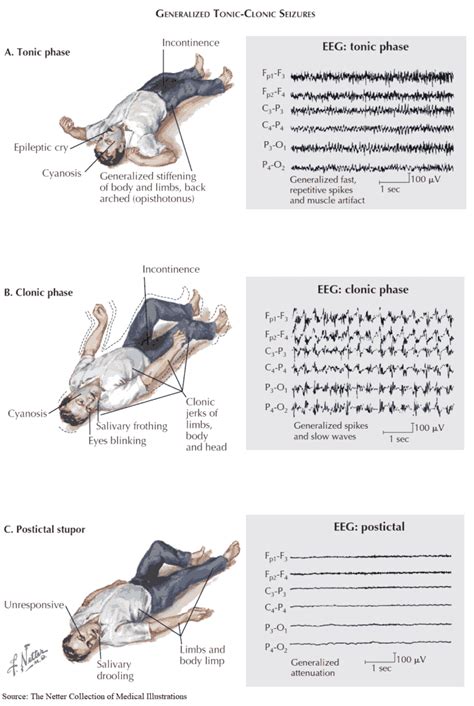 All About Epilepsy and Seizures: From Diagnosis to Treatment - Manual ...