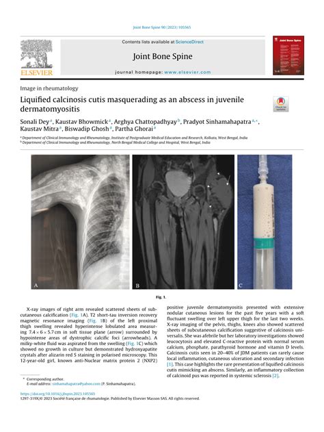 Pdf Liquified Calcinosis Cutis Masquerading As An Abscess In Juvenile