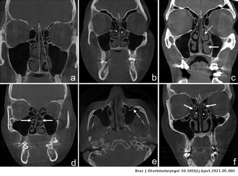 The Effect Of Anatomical Variations Of The Sinonasal Region On