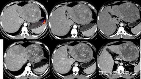 为什么要对肝癌进行分期？肝癌的分级和分期是怎样的？ 知乎