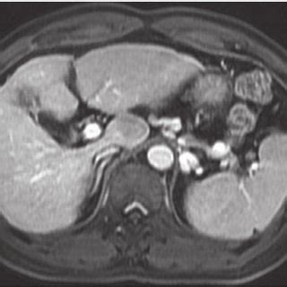 Operative picture showing a large lesion in the caudate lobe | Download ...