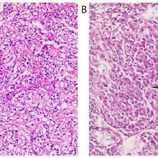 Pathological Findings A Pathological Analysis Of The Resected Tumor