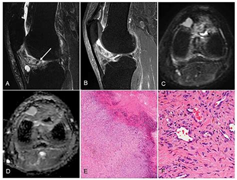 Radiological And Pathological Characteristics Of Synovial Hemangioma Of