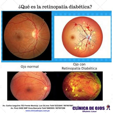 Clínica De Ojos Oftalmic Láser ¿qué Es La Retinopatía Diabética