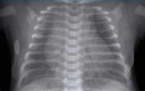 Normal Infant Chest Xray