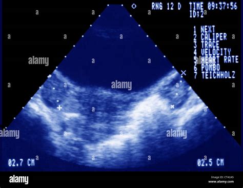 Polycystic ovary ultrasound hi-res stock photography and images - Alamy