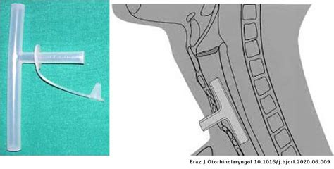 Our 12 Year Experience With Montgomery T Tube In The Management Of