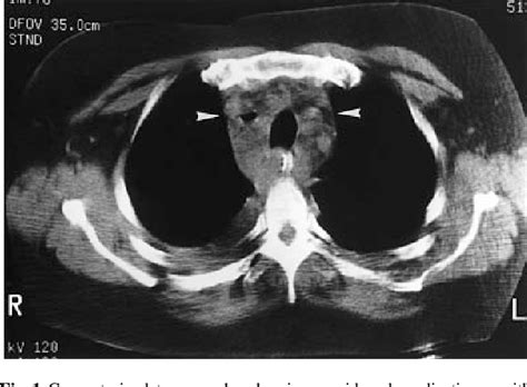 Figure From Infected Mediastinitis Secondary To Perforation Of