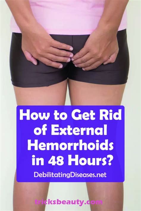 How To Get Rid Of External Hemorrhoids In 48 Hours Hemorrhoids