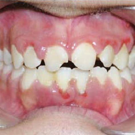 Pdf Gingival Hyperplasia As An Early Diagnostic Oral Manifestation In