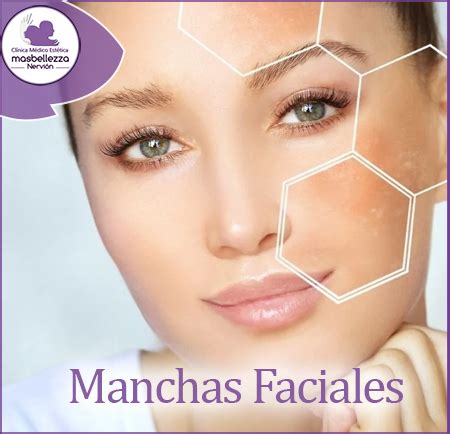 Manchas Faciales Y Su Prevenci N