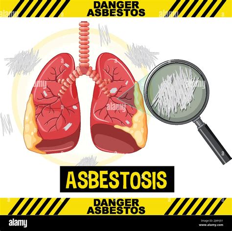 Diagram Showing Asbestosis In Lungs Illustration Stock Vector Image