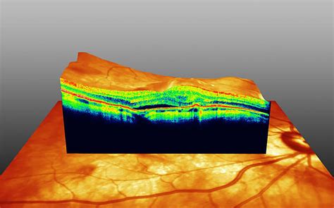 Optische Koh Renztomographie Oct Augencentrum Dresden De