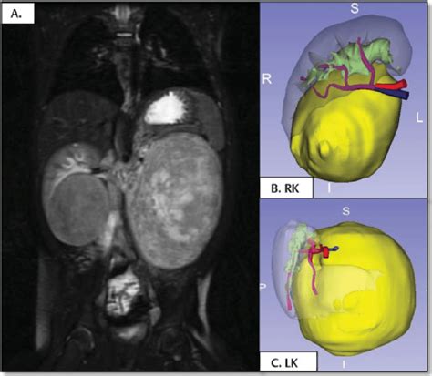 Case 1 A Coronal Mri Section Showing Both Kidneys Affected By Wilms