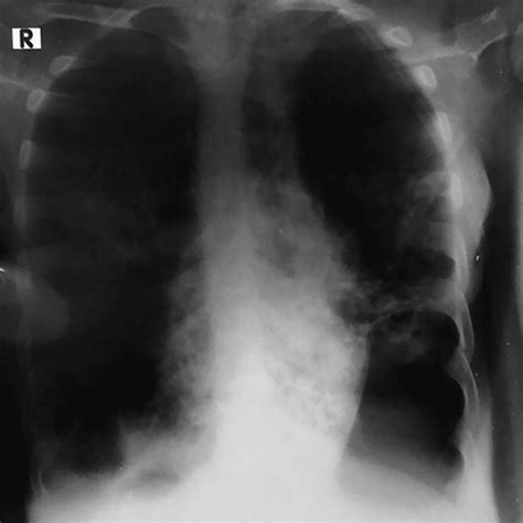 Chest X Ray Of The Patient Showing Bilateral Bronchiectasis With Cyst Download Scientific