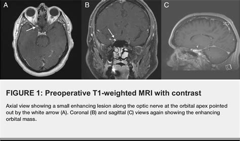 Figure 1 from A Rare Case of Optic Nerve Schwannoma: Case Report and ...