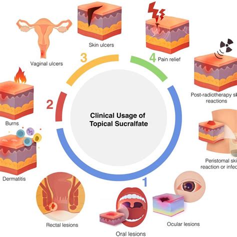 The molecular mechanism of action of sucralfate in epidermal and dermal ...