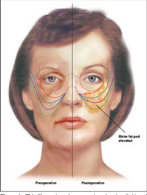 Pdf Malar Fat Pad Repositioning In Facelifting A Simple Technique Of