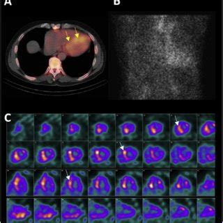 A Single Photon Emission Computed Tomography Imaging Revealing