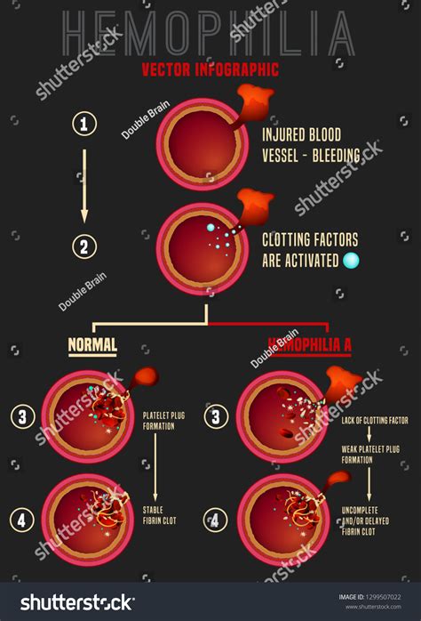 Hemophilia Blood Clotting Stages Vessel Cuts: vetor stock (livre de direitos) 1299507022 ...