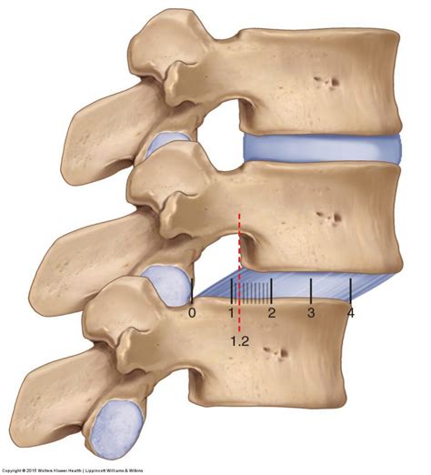 Spondylolisthesis — Experience Physical Therapy - Buffalo Grove, IL