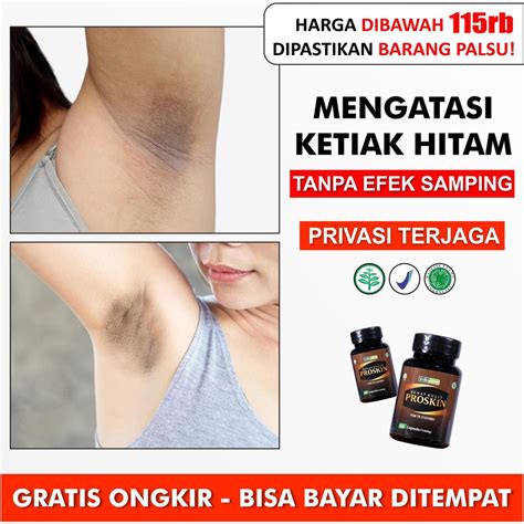 Jual Obat Gatal Ketiak Hitam Bintik Kecil Karena Keringat Berlebih