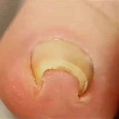 Pincer Nail Also Known As The Trumpet Nail Consists Of Dramatic