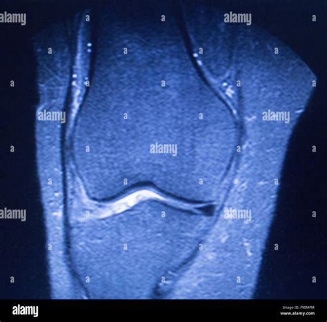 Mri Magnetic Resonance Imaging Medical Scan Test Results Showing