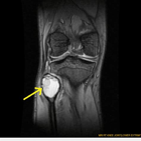 Types Of Bone Cysts And Pathogenesis Of Aneurysmal Bone Cysts