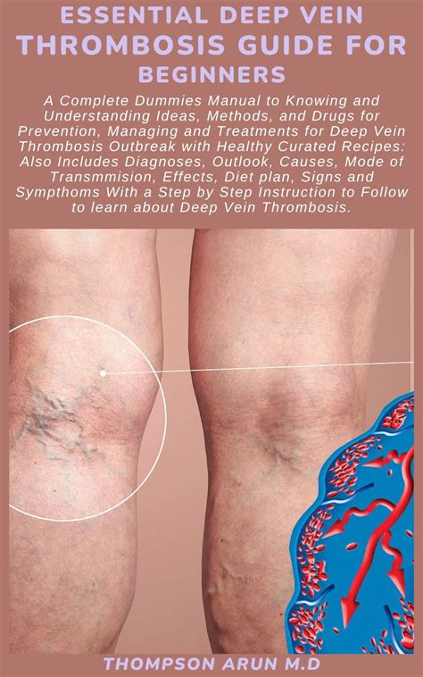 Essential Deep Vein Thrombosis Guide For Beginners A Complete Dummies Manual To Knowing And