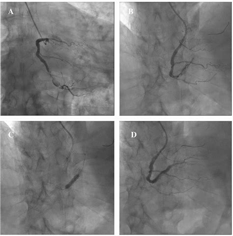 Frontiers Treatment And Outcome Of Patients With Coronary Artery