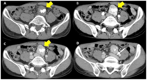 Surgical Resection For Pelvic Retroperitoneal Castleman S Disease A