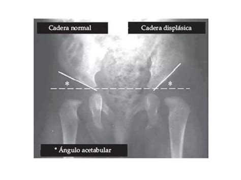 Luxación Congénita De Cadera Ppt