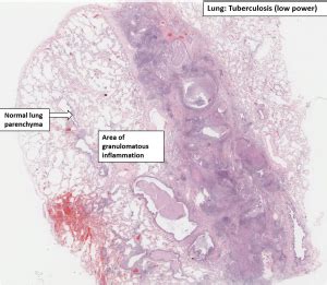 Lung Tuberculosis Nus Pathweb Nus Pathweb