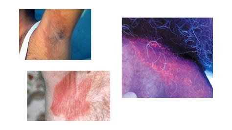 Common Cutaneous Infections And Infestations Mohammed AlHaddab MD