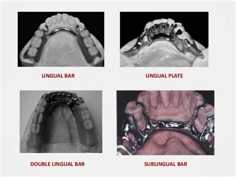 Designing A Removable Partial Denture Kennedys Classification