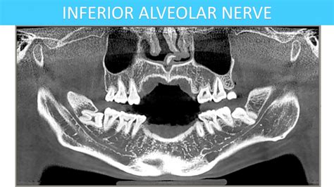 Ear Xray Ent Xray Cbct Scans Auckland New Zealand