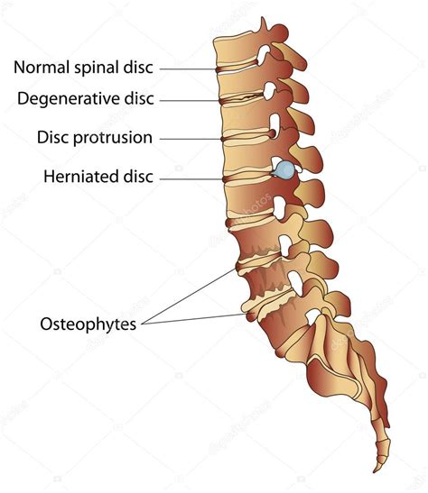 Some Spinal Diseases Disc Herniation Osteophytes Degenerative