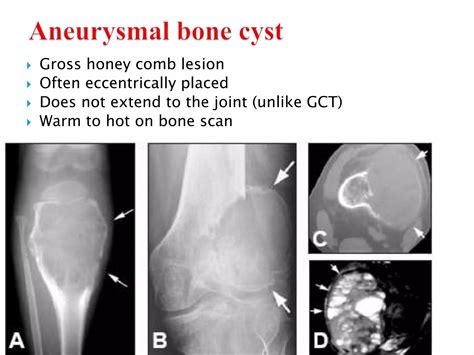 Radiology of Bone Tumours | PPT | Free Download