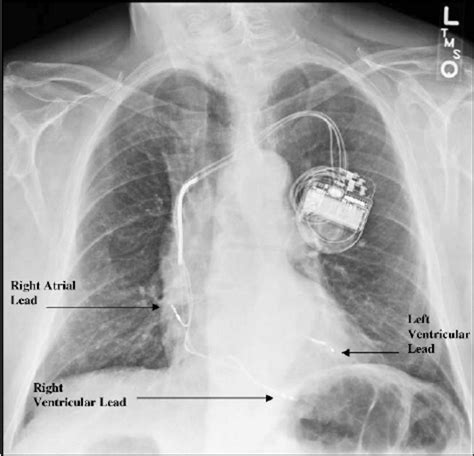 Chest X Ray Showing Pacing Leads In The Right Atrium Right Ventricle