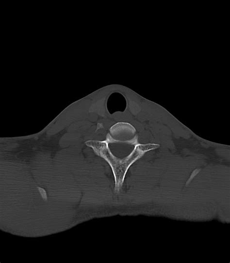 Arrow Injury To The Face Radiopaedia Axial Bone Window