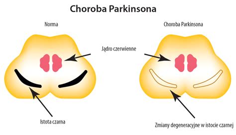 Fizjoterapia W Chorobie Parkinsona