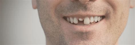 broken teeth neutral bay nsw sydney emergency dentist