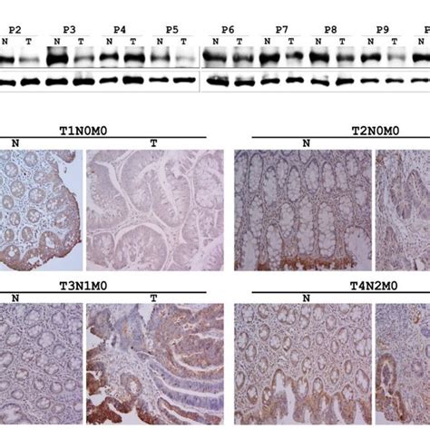 Endogenous Vegfa Levels In Human Colorectal Cancer Crc Tissues A