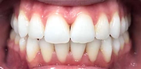 healthy bottom teeth