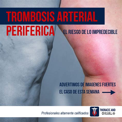 Trombosis arterial periférica Casos